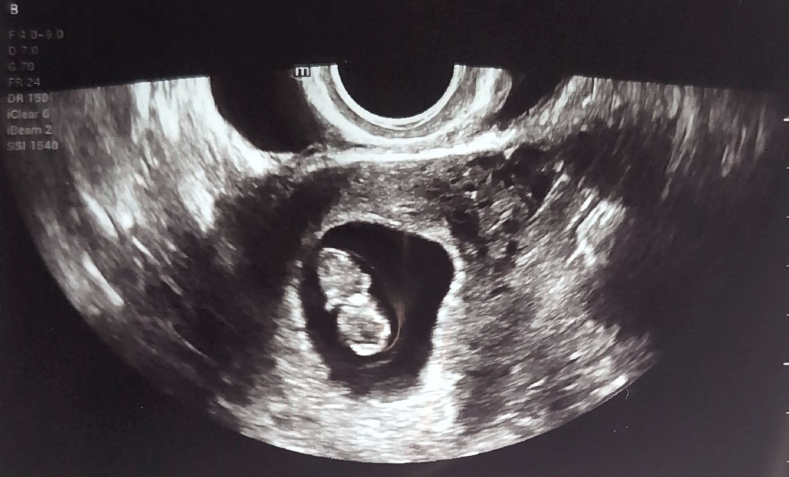 Ultrasound Image